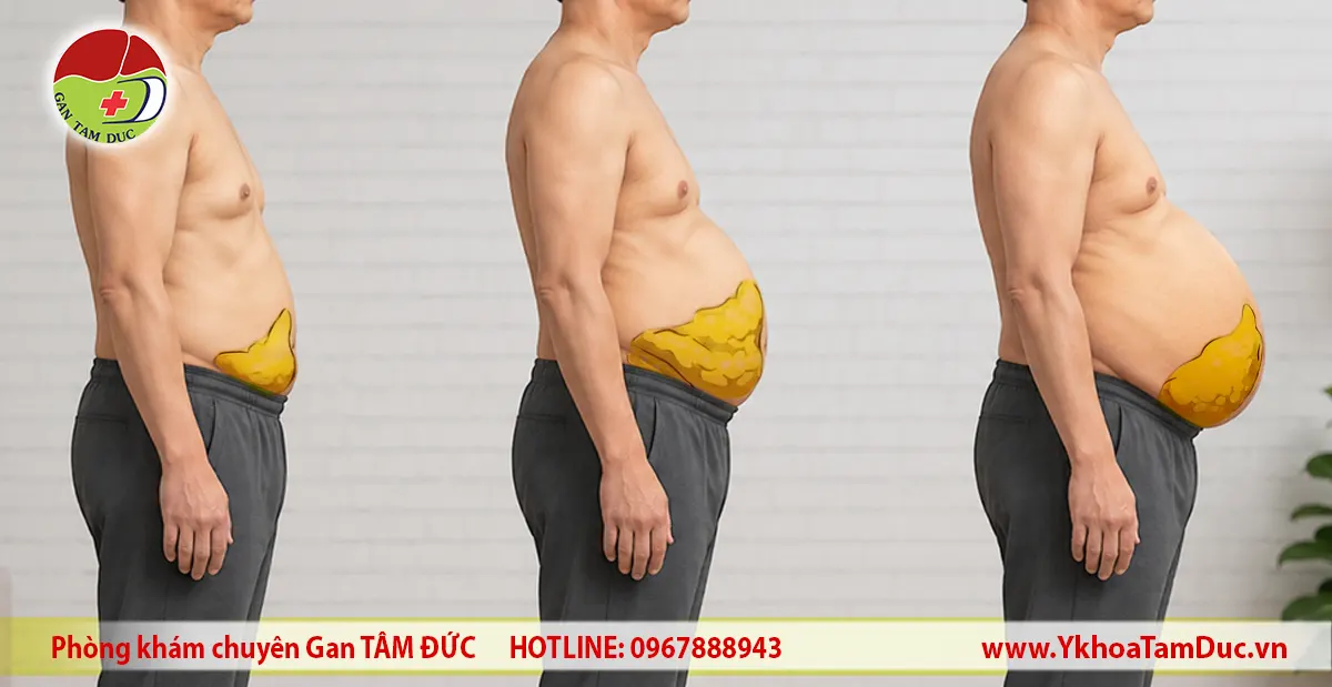 Gan nhiễm mỡ có làm bụng to không? 1 Hình minh họa ba dạng bụng to nhìn từ bên hông với phần màu vàng biểu diễn sự phân bố mỡ trong vùng bụng. Hình dùng để giải thích mỡ bụng và không thể xác định nguyên nhân bệnh lý như gan nhiễm mỡ.