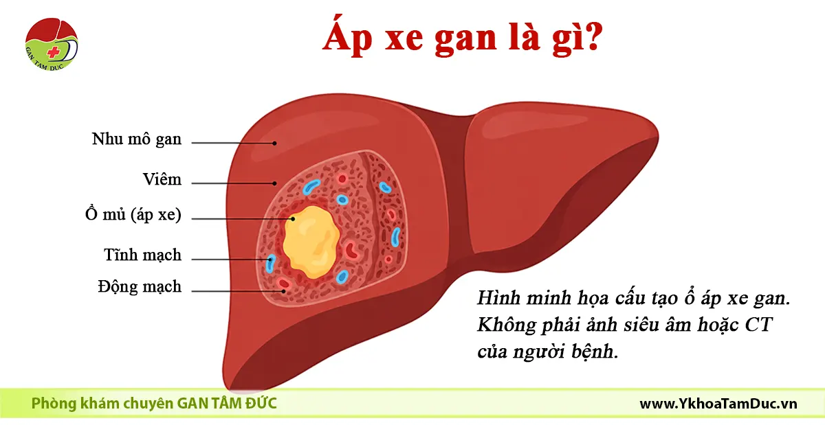 Áp xe gan có phải là ung thư không? 1 Hình minh họa áp xe gan cho thấy ổ mủ nằm trong nhu mô gan, bao quanh bởi mô viêm và các mạch máu trong gan.