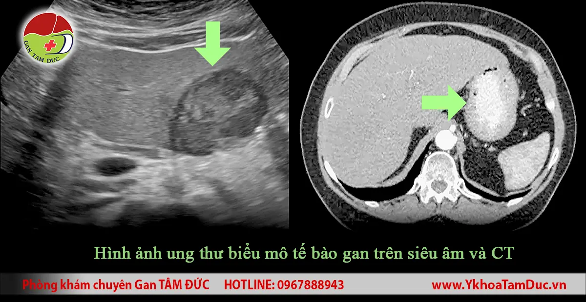 Áp xe gan có phải là ung thư không? 3 Hình gồm siêu âm và CT bụng minh họa một tổn thương gan được đánh dấu bằng mũi tên xanh. Đây là ví dụ về hình ảnh ung thư biểu mô tế bào gan trên hai phương tiện chẩn đoán hình ảnh khác nhau. Chỉ riêng hình ảnh không đủ để xác định chẩn đoán trong mọi trường hợp.