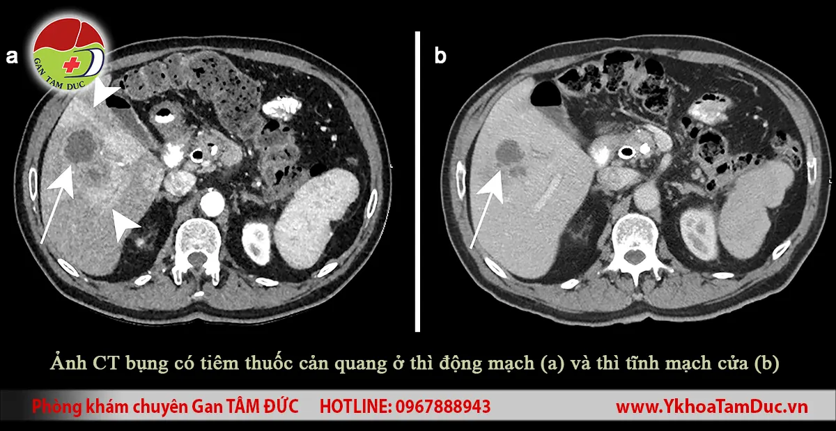 Áp xe gan có phải là ung thư không? 4 Hai ảnh CT bụng có tiêm thuốc cản quang ở thì động mạch và thì tĩnh mạch cửa minh họa nhiều ổ áp xe gan do vi khuẩn tại phân thùy V của gan trong một ca bệnh được báo cáo trên y văn. Mũi tên trắng đánh dấu các ổ áp xe, còn đầu mũi tên chỉ vùng thay đổi tưới máu quanh tổn thương.