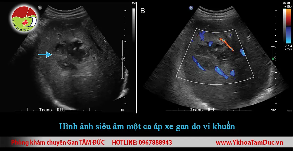 Áp xe gan có phải là ung thư không? 2 Hai hình siêu âm gan gồm siêu âm B-mode và Doppler màu minh họa một ổ áp xe gan do vi khuẩn đã được xác nhận trong nghiên cứu. Mũi tên chỉ vùng tổn thương giảm âm, trong khi Doppler màu cho thấy tăng tưới máu quanh ổ áp xe.