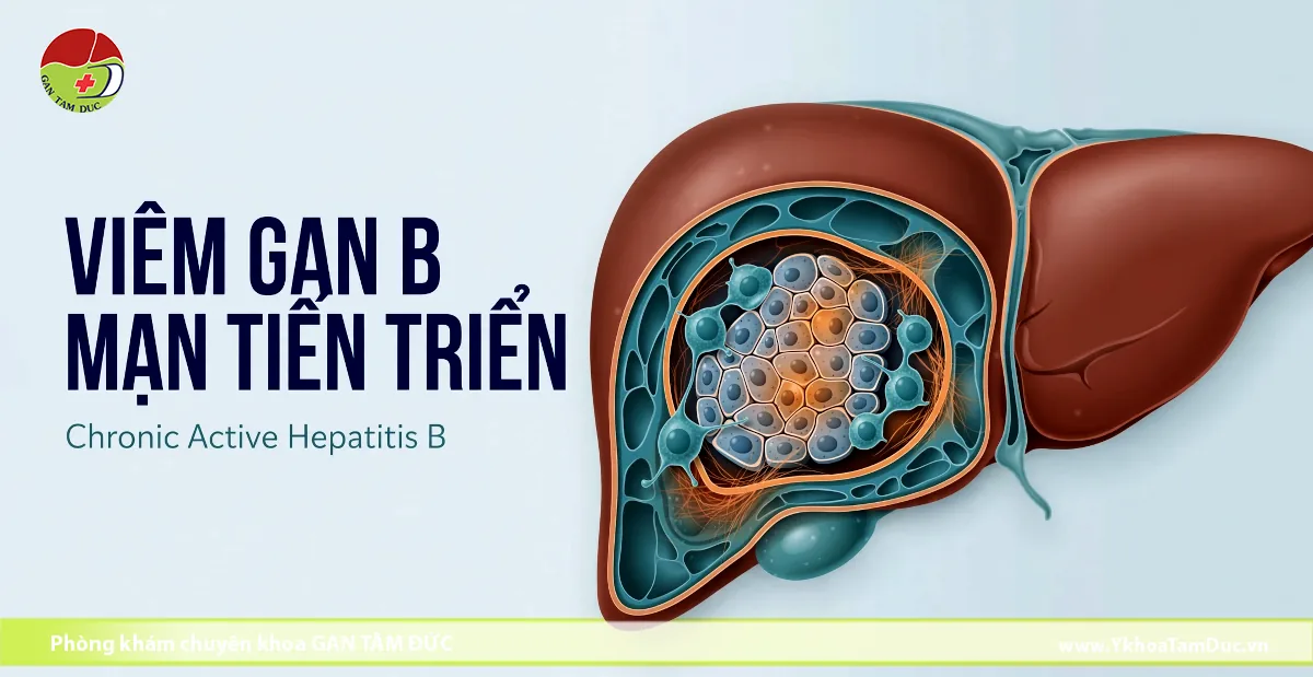 Viêm Gan B Mạn Tiến Triển Là Gì? Dấu Hiệu & Điều Trị 1 Mô hình đồ họa giải phẫu gan người hiển thị vùng cắt lớp vi thể bị viêm và tổn thương tế bào do virus viêm gan B mạn tính thể hoạt động (tiến triển).